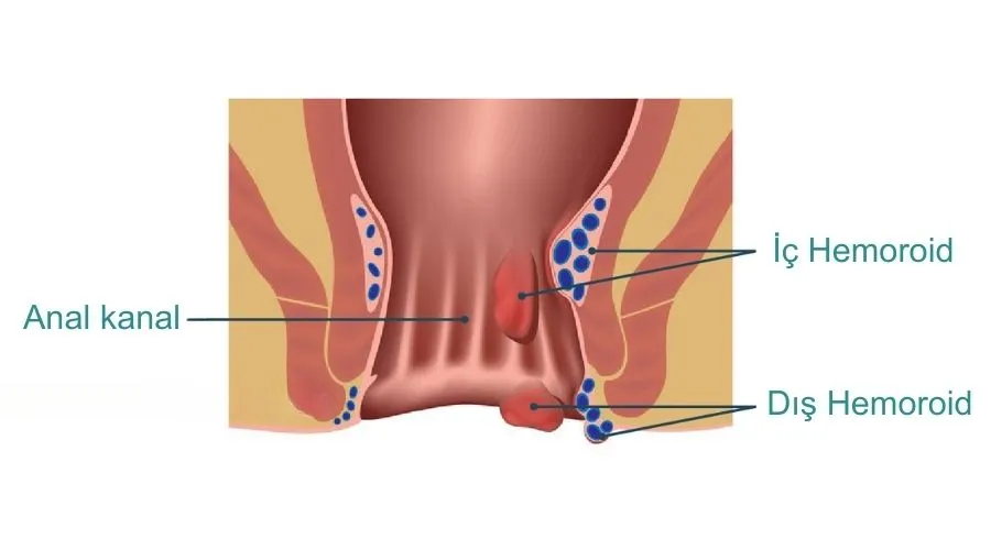 Anal kanal ve iç dış hemoroid anatomisi gösterilmektedir.
